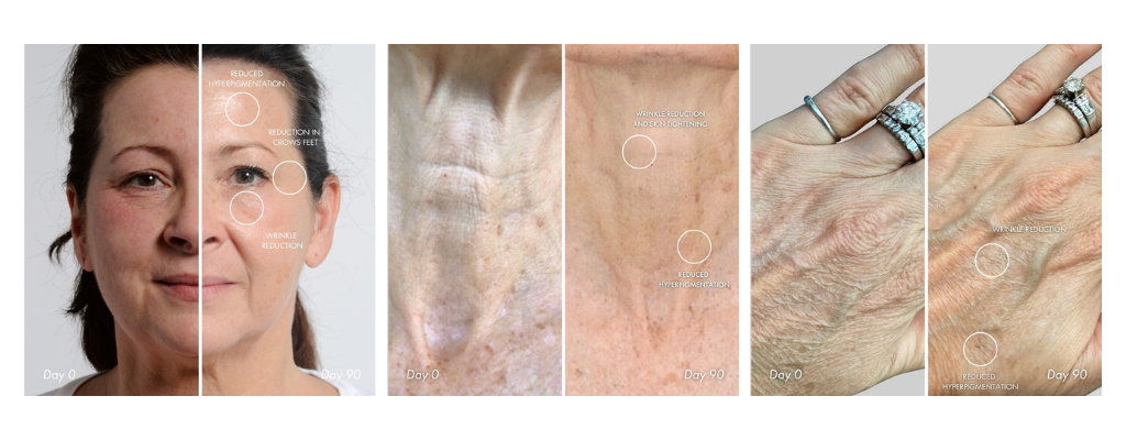 Before-and-after wrinkle reduction results from the NIRA Pro Laser on face, neck, and hands